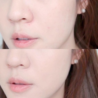 The ordinary AHA 30% BHA 2% peeling solution