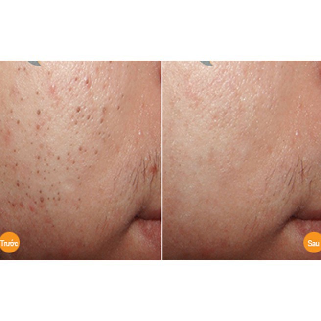 Kem Giảm Sưng Giảm Mụn Đầu Đen - Ziaja Med Xanh | BigBuy360 - bigbuy360.vn