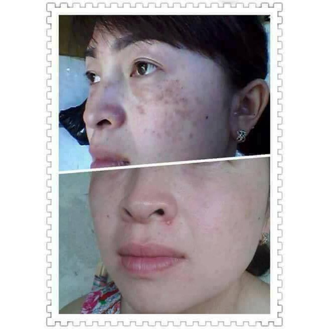 💗 MỚI 💗 Hết Nám Tàn Nhang Lâu Năm Nhờ Serum Pukel Plus
