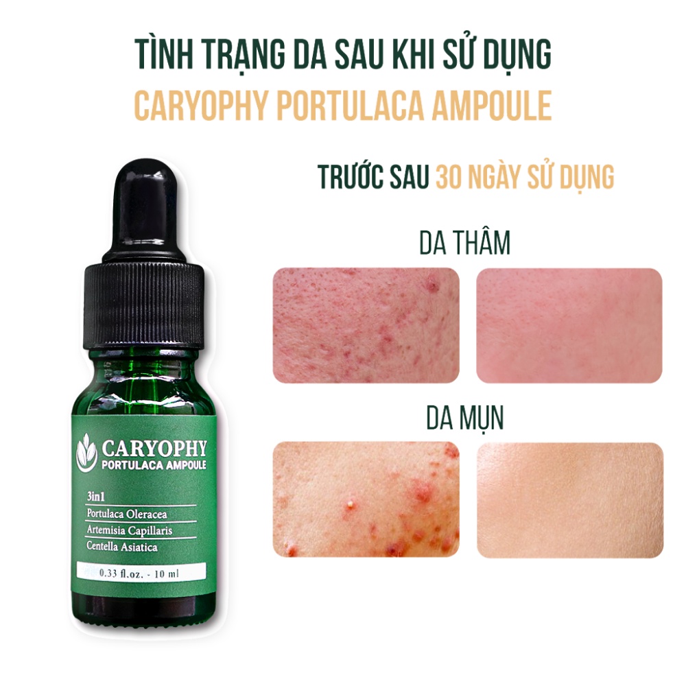 Serum Caryophy Portulaca Ampoule 10ml chiết xuất từ rau má giúp giảm mụn hiệu quả