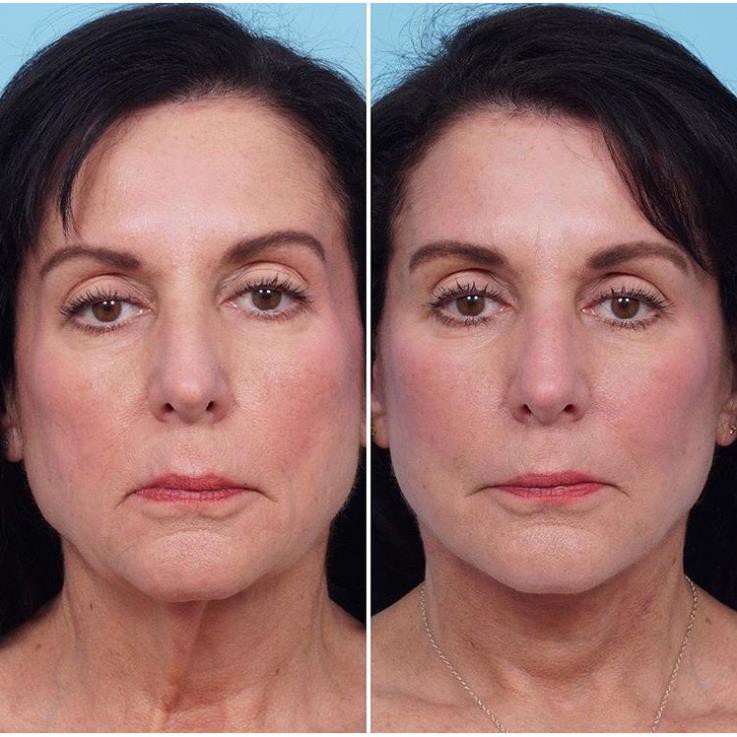 Big Gel 60 Cặp Facial Galvanic Nuskin