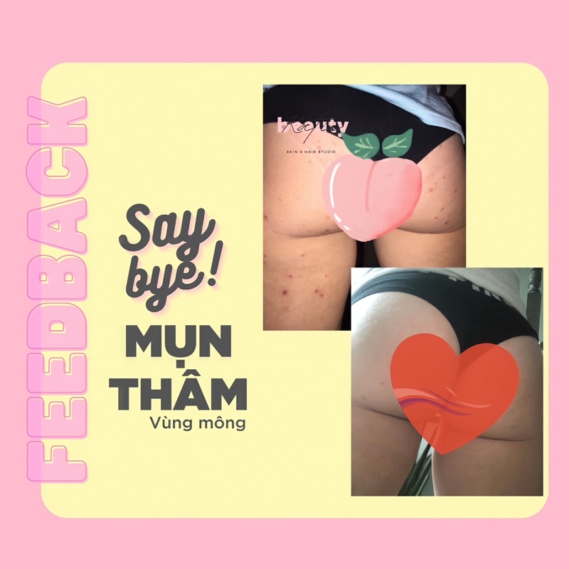 Kem thoa thâm Mông, mụn Mông, Bẹn, Nách, Lưng, Cùi chỏ, Đầu gối  Dark spot lotion