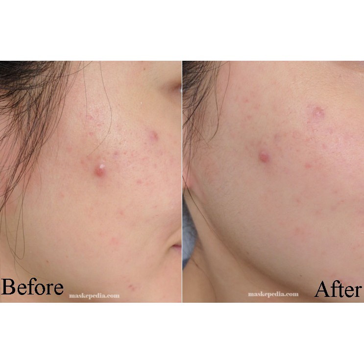 Mask Tràm Trà Cho Da Mụn, Kiểm Soát Dầu Naruko Tea Tree Shine Control & Blemish Clear Mask 26ml Kbeautyvn | Thế Giới Skin Care