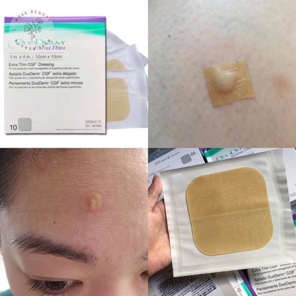 Miếng dán mụn DuoDerm Extra Thin nhanh lành mụn | BigBuy360 - bigbuy360.vn