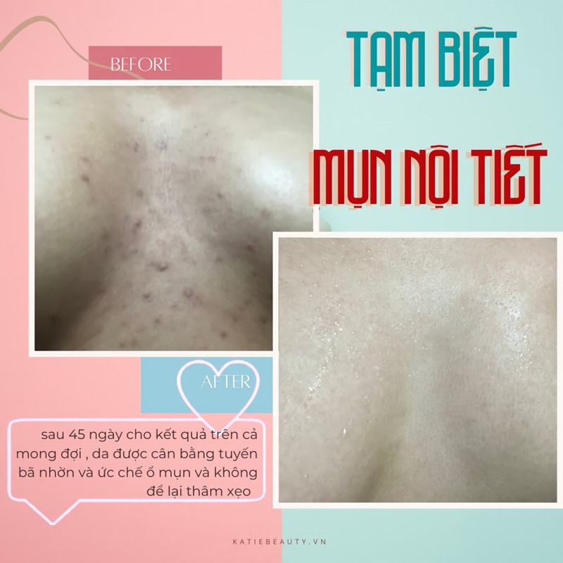 Kem thoa thâm Mông, mụn Mông, Bẹn, Nách, Lưng, Cùi chỏ, Đầu gối  Dark spot lotion