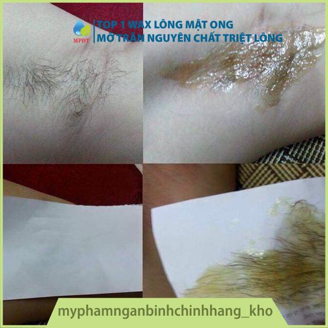 Combo wax lông và mỡ trăn tẩy lông nách, ria mép, lông cánh tay, chân, tẩy lông bikini tại nhà