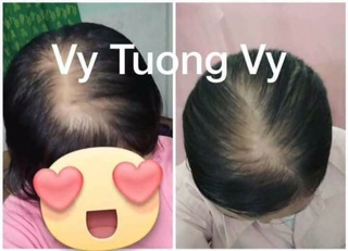 Combo kích mọc tóc