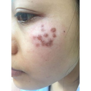 PEEL TCA USA CHẤM SEO THAM NAM DOI MOI