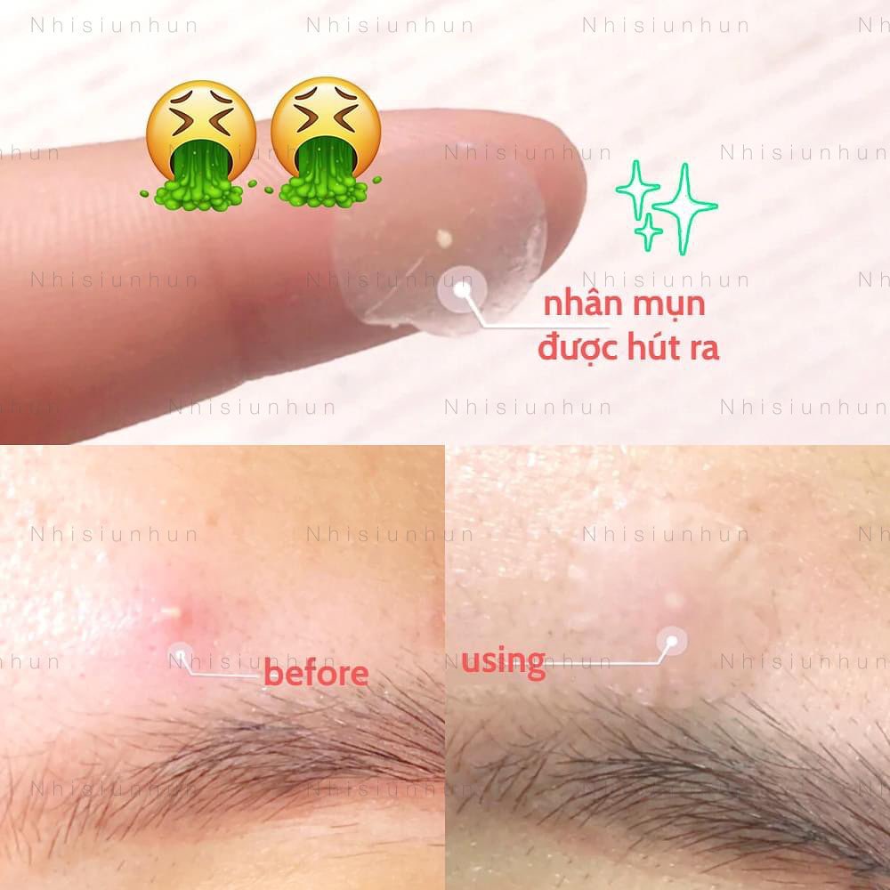 Miếng dán Some by mi Clear Spot patch