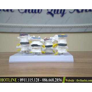 Bộ mô hình các bệnh lý cột sống - Thoát vị đĩa đệm -Xẹp đĩa đệm -Lồi đĩa đệm