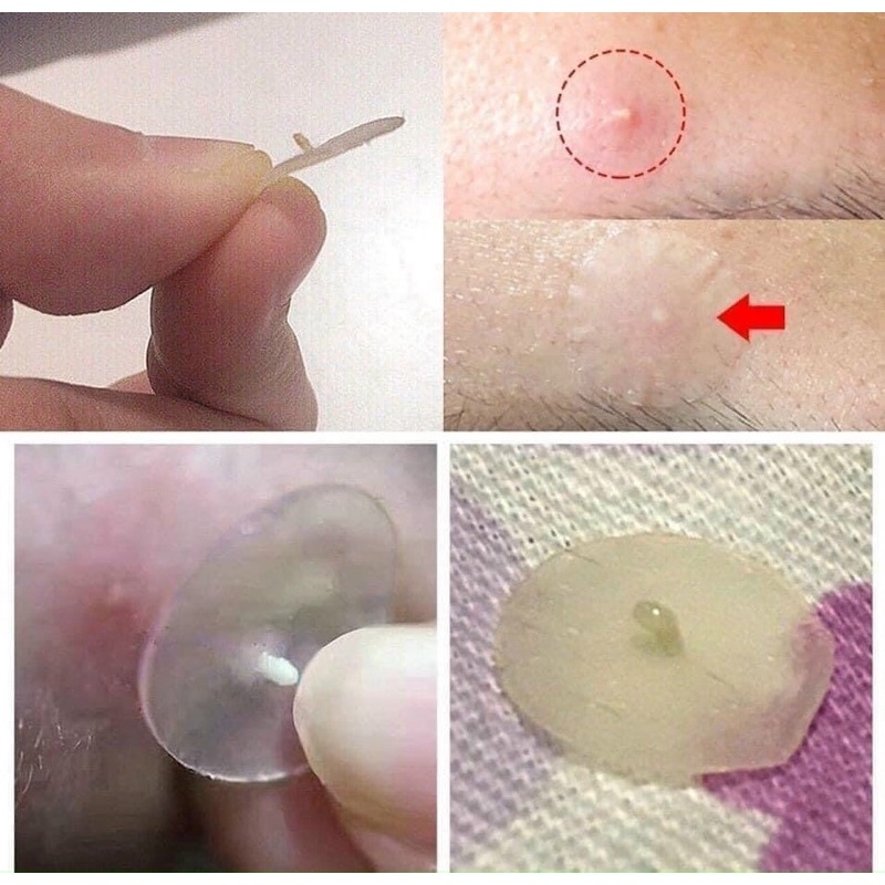 Miếng dán mụn Ciracle Red Spot Acne Pimple Patch 1 gói 24 miếng