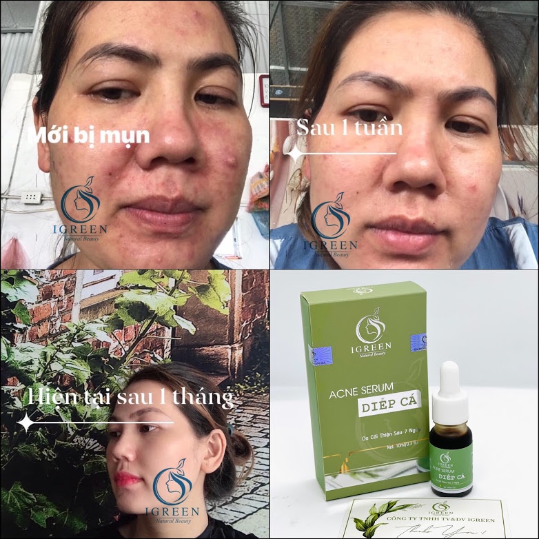 Serum Diếp Cá GIẢM MỤN, THÂM, SE KHÍT LỖ CHÂN LÔNG IGREEN - Acne Serum Diếp Cá IGREEN