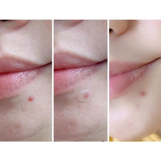 Miếng Dán Ciracle Red Spot Acne Pimple Patch.