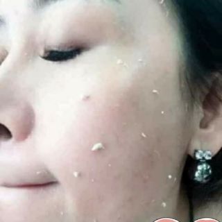 TẨY DA TẾ BÀO CHẾT KỲ ĐÀO
