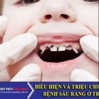Vecniflour thuốc phòng sâu răng ở trẻ em và ê buốt ở người lớn