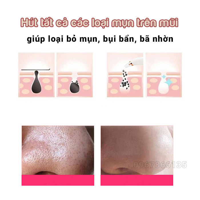 Máy hút mụn đầu đen BLACK HEAD cao cấp 3 đầu hút
