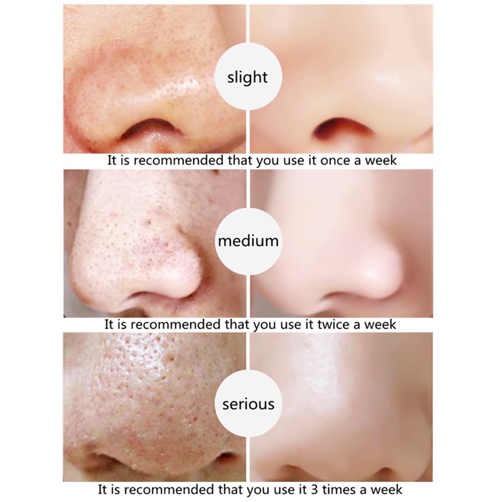 [Hàng mới về] Mặt nạ lột mụn đầu đen vùng chữ T đa năng giúp làm sạch sâu cho da mặt