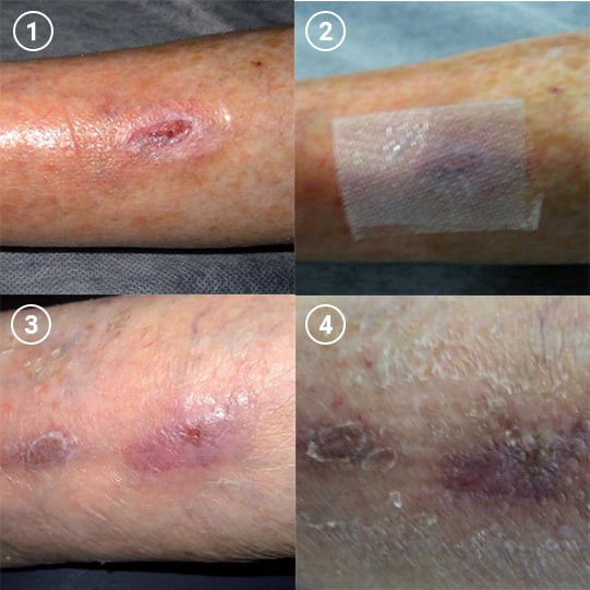 Tấm lưới silicone bảo vệ vết thương Mepitel One