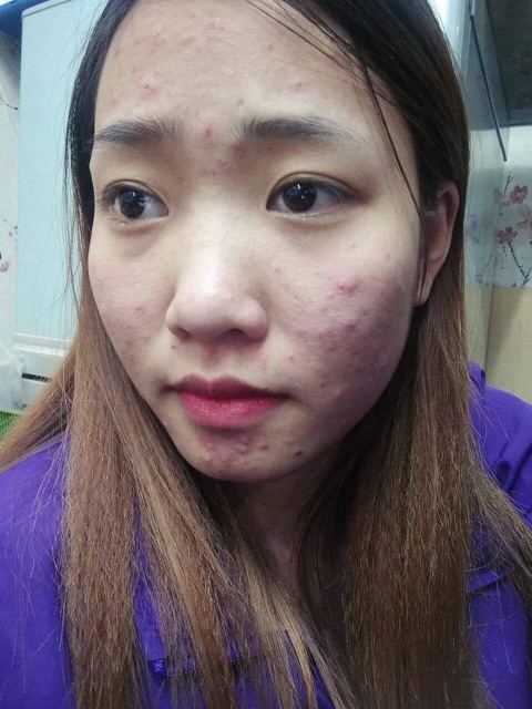 Serum Mụn Amoli | BigBuy360 - bigbuy360.vn