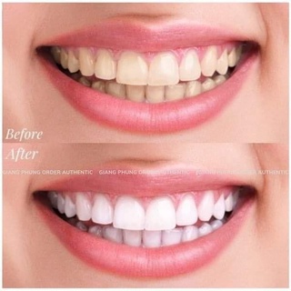 Set trắng răng White Glo White