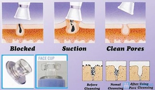 MÁY HÚT MỤN MINI SPOT CLEANER