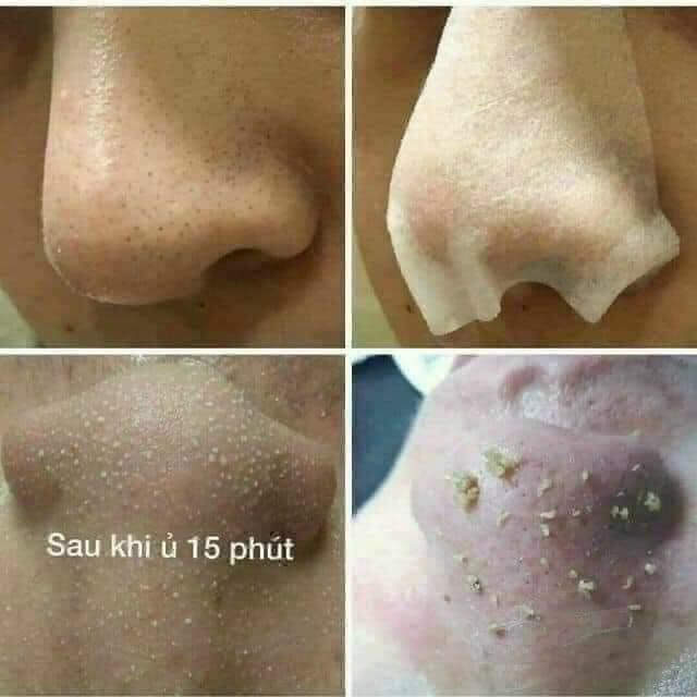 chai ủ mụn medipeel hàn quốc