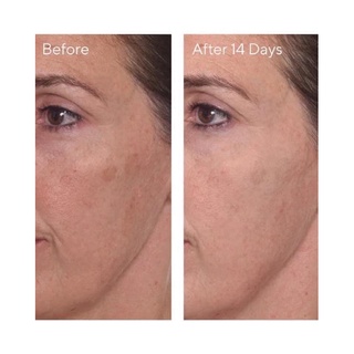 Tinh Chất Mờ Thâm Serum Murad Rapid Dark Spot Correcting Serum Mini 5ml