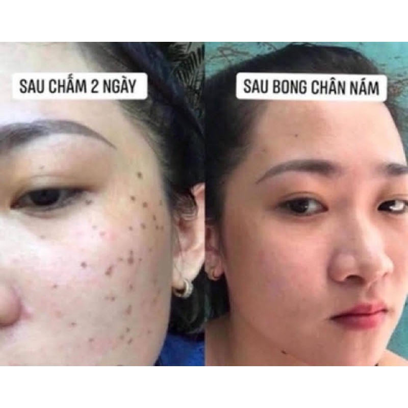 Dung Dịch Chấm Nám, Tàn Nhang, Làm Đầy Sẹo Rỗ, Xóa Nốt Ruồi Handmade | BigBuy360 - bigbuy360.vn