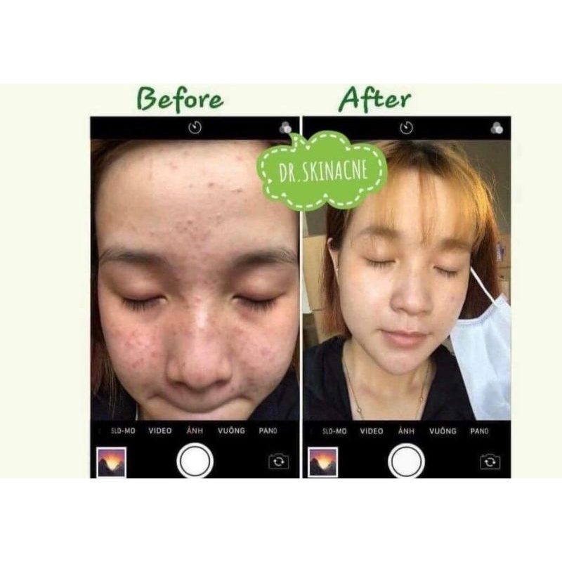 MẪU MỚI KEM TRẮNG💖 KEM GIẢM MỤN NGỪA THÂM 𝑫𝑹 𝑺𝑲𝑰𝑵𝑨𝑪𝑵𝑬 CHÍNH HÃNG