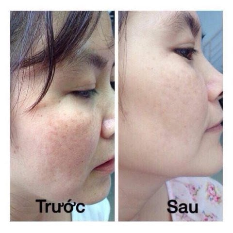 Viên Uống Trắng Da Hủy Nám Tàn Nhang Melaforyou Hàn Quốc Trong Uống Ngoài Bôi Siêu Kích Trắng Chống Lão Hóa | BigBuy360 - bigbuy360.vn