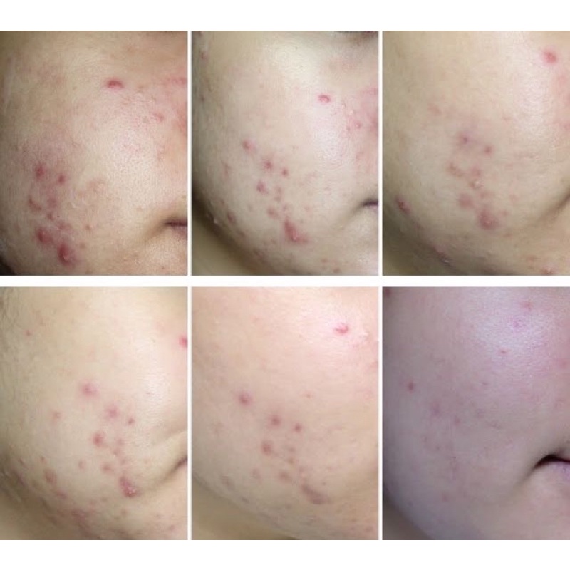 Bộ 3 sản phẩm cho da mụn và da dầu Naris Acne Grand Nhật Bản