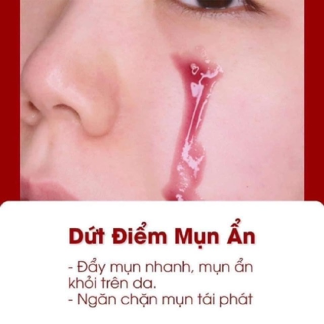 Tinh chất tái tạo da Red Peel Tingle Serum 35ml, Serum peel da hóa học RED PEEL TINGLE SERUM