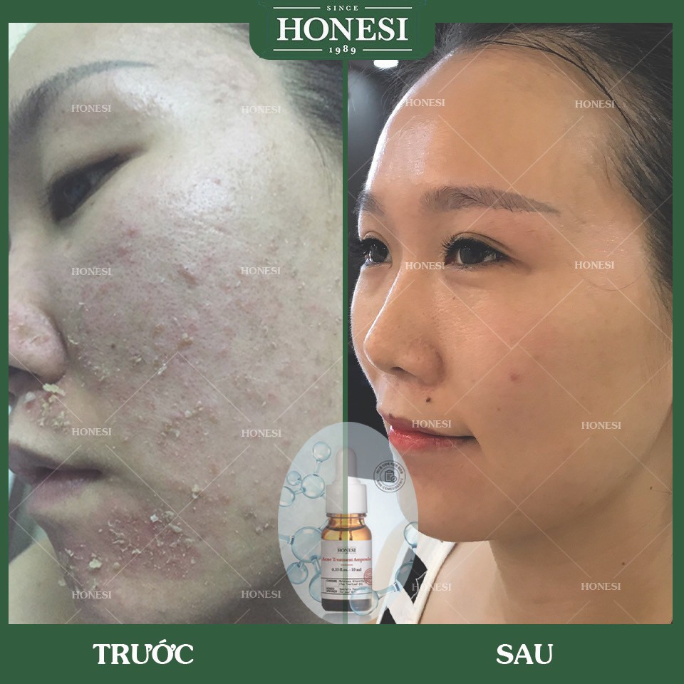 Sét Serum Giảm Mụn Nhanh Lành Tính HONESI Acne Treatment Ampoule (10ml x 5 lọ) - Hàn Quốc BONGSHOPAUTHENTIC | BigBuy360 - bigbuy360.vn