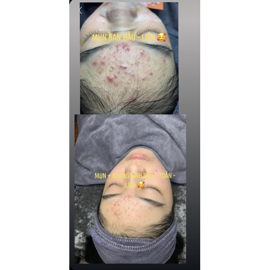 Serum Caramel Esence Viện Da Liễu Nhật Bản Giảm Mụn Dưỡng Da