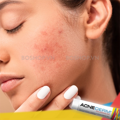 Kem Giảm Mụn Acne Derm Làm Trắng Da 20% Axit Azelaic 20g