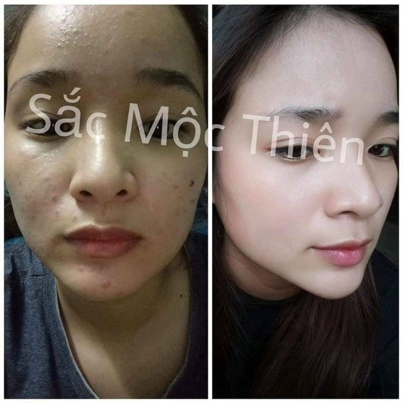 Combo Tinh Chất Tái Tạo Da Và Linh Chị Mộc Sắc Mộc Thiên