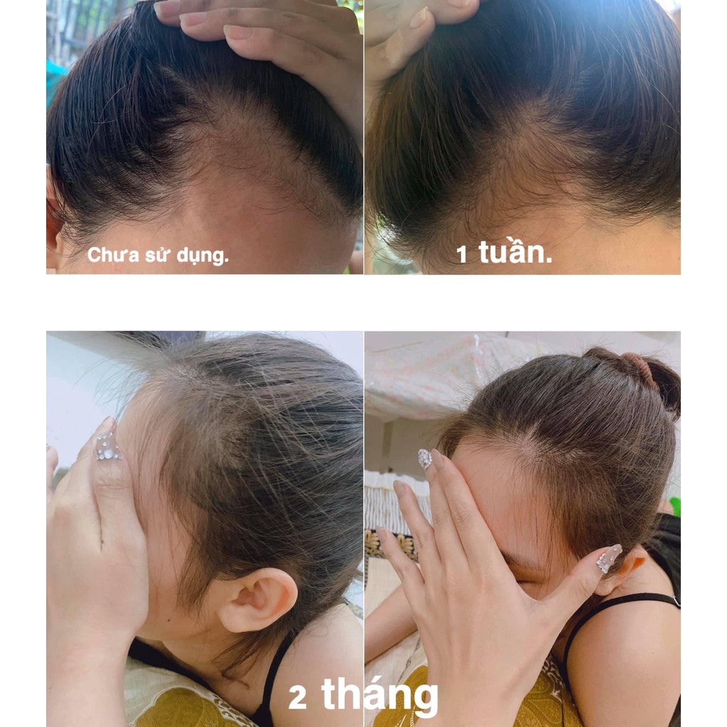 Tinh chất thảo dược & vỏ bưởi kích thích mọc tóc nhanh và giảm rụng hiệu quả - Koko Natural Official 30ml