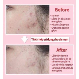 𝐊𝐞𝐦 𝐇𝐨̂̃ 𝐓𝐫𝐨̛̣ 𝐆𝐢𝐚̉𝐦 𝐌𝐮̣𝐧 #Ciracle Red Spot (chính hãng, date 2023)