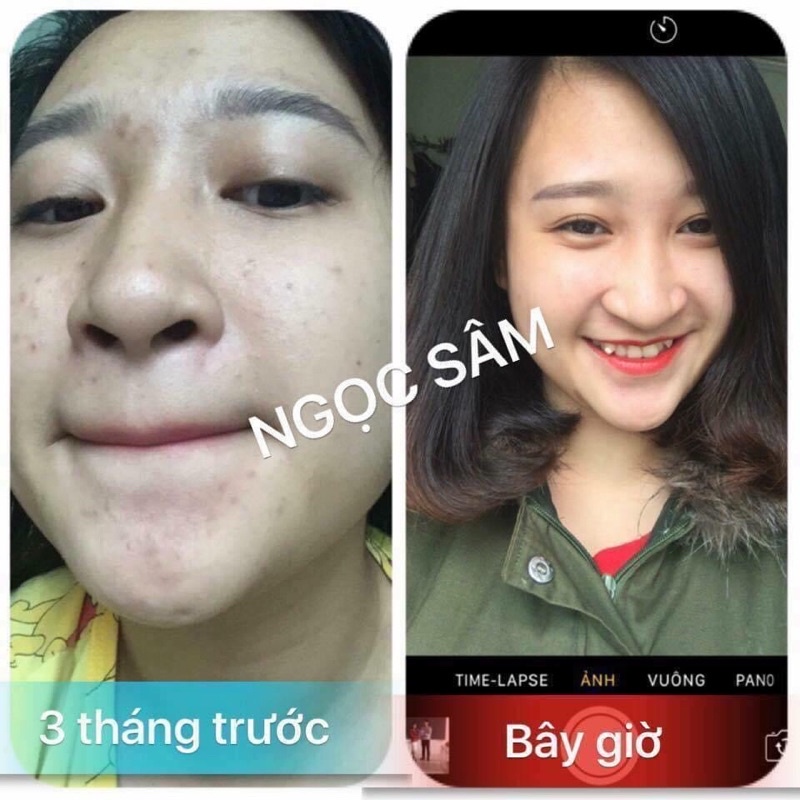 [Ngọc Sâm]Lăn mini 10ml ngăn ngừa mụn mờ thâm