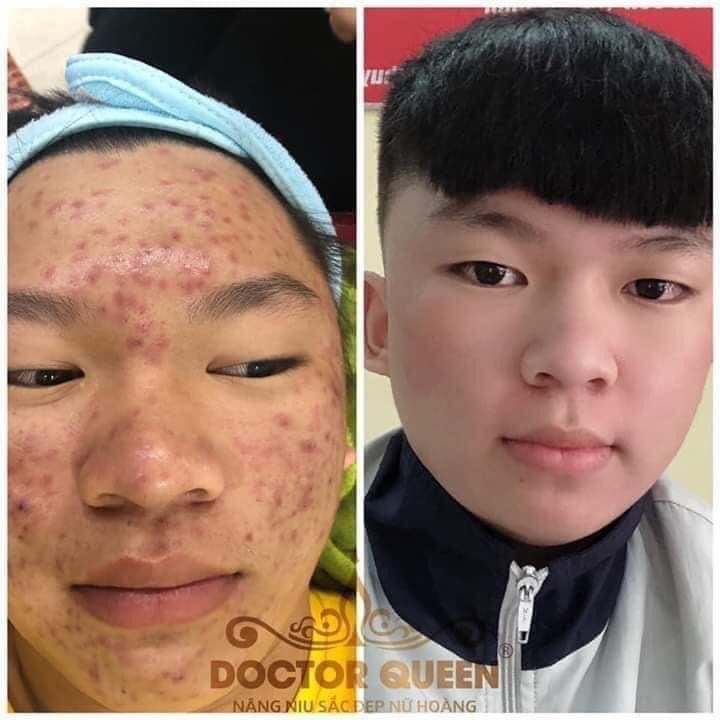 SERUM DETOX MỤN DOCTOR QUEEN - (Ngừa tất cả các loại mụn,thâm,. đào thải phục hồi tái tạo da,da yếu, giãn mao mạch,...)