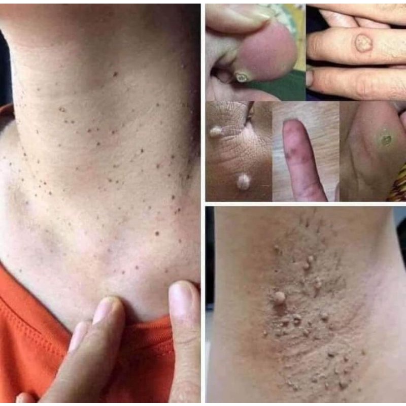 Gel tẩy mụn cóc nốt ruồi Nga chính hãng