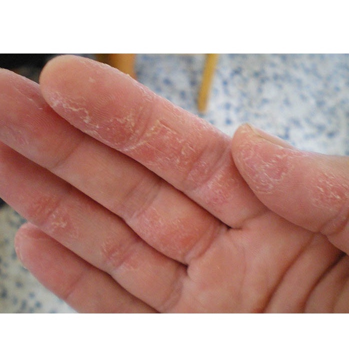 THẢO DƯỢC HẾT BAY BONG TRÓC DA NGÓN TAY, LÒNG BÀN TAY, BÀN CHÂN