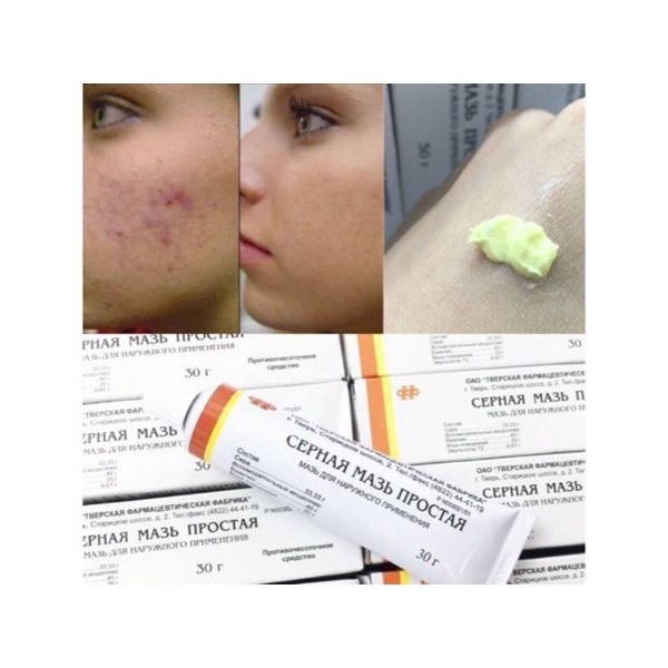 Kem mụn Lưu Huỳnh Cepha -Nga