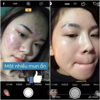SERUM CHẤM MỤN 12H HUỲNH ĐỖ