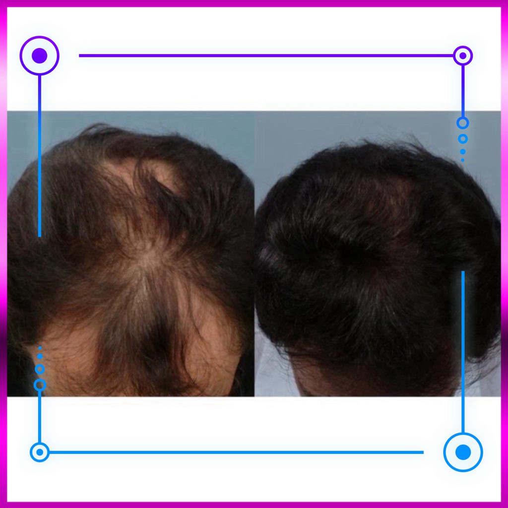 SALE SỐC 60% Viên uống hỗ trợ mọc tóc Biotin 10,000mcg - Dùng kèm Minoxidil SALE SỐC 60%