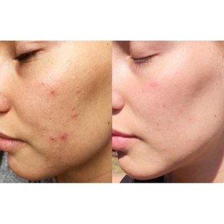 TẨY DA CHẾT The Ordinary AHA 30% + BHA 2% Peeling Solution