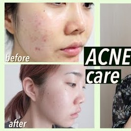 Bộ Giảm Sẹo Kim lăn DRS Dermaroller ĐỨC + Tinh chất TBG Ampoule