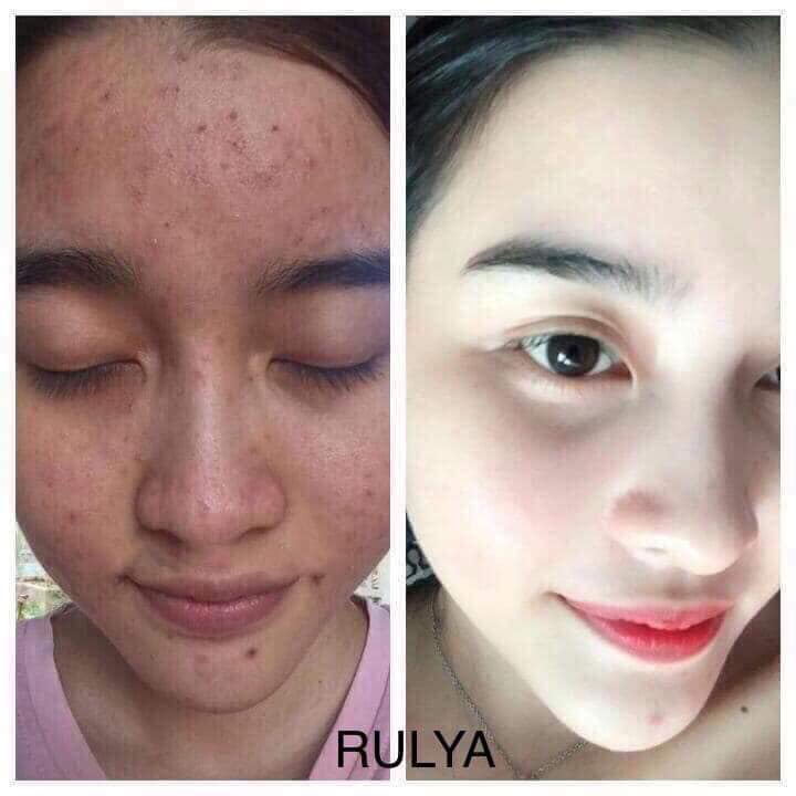 Serum Ngừa Mụn Chính Hãng Rulya Anti Acne - Hết Mụn Trong 7 Ngày | BigBuy360 - bigbuy360.vn