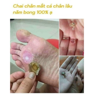 Chấm Mụn Cóc, Mụn Cơm, Chai Sần Hiệu Quả