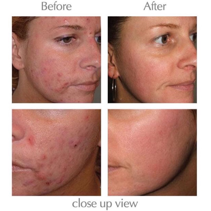 Gel bôi mụn cùng công thức với Differin Adapalene 0.1% dành cho da mụn ẩn mụn mủ viêm mụn đầu đen và da sần sùi | BigBuy360 - bigbuy360.vn